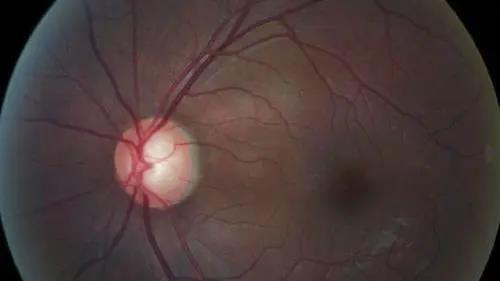 青光眼的克星来袭，助力患者远离视力的“窃贼”