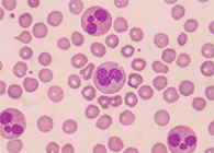 一种神秘颗粒被发现了！它能否成为败血症早筛标志物？